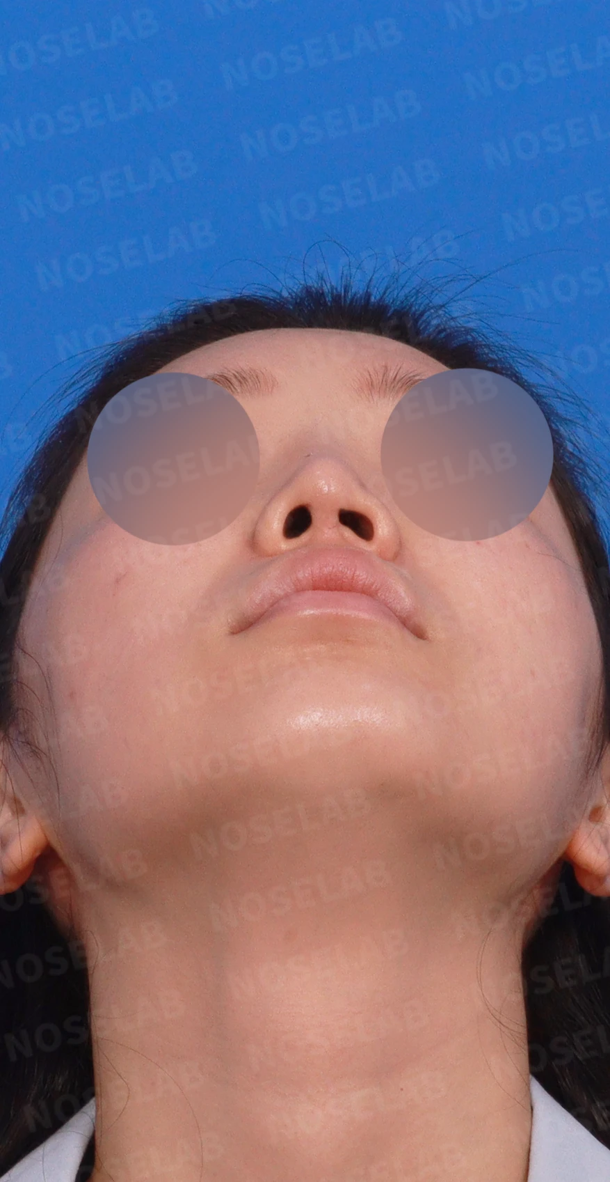 연골 노출 복원과 날개 연골 재건으로 안전하고 자연스러운 코 — 디자인 상담 우측 측면, 비스듬한 측면, 비공 사진입니다.