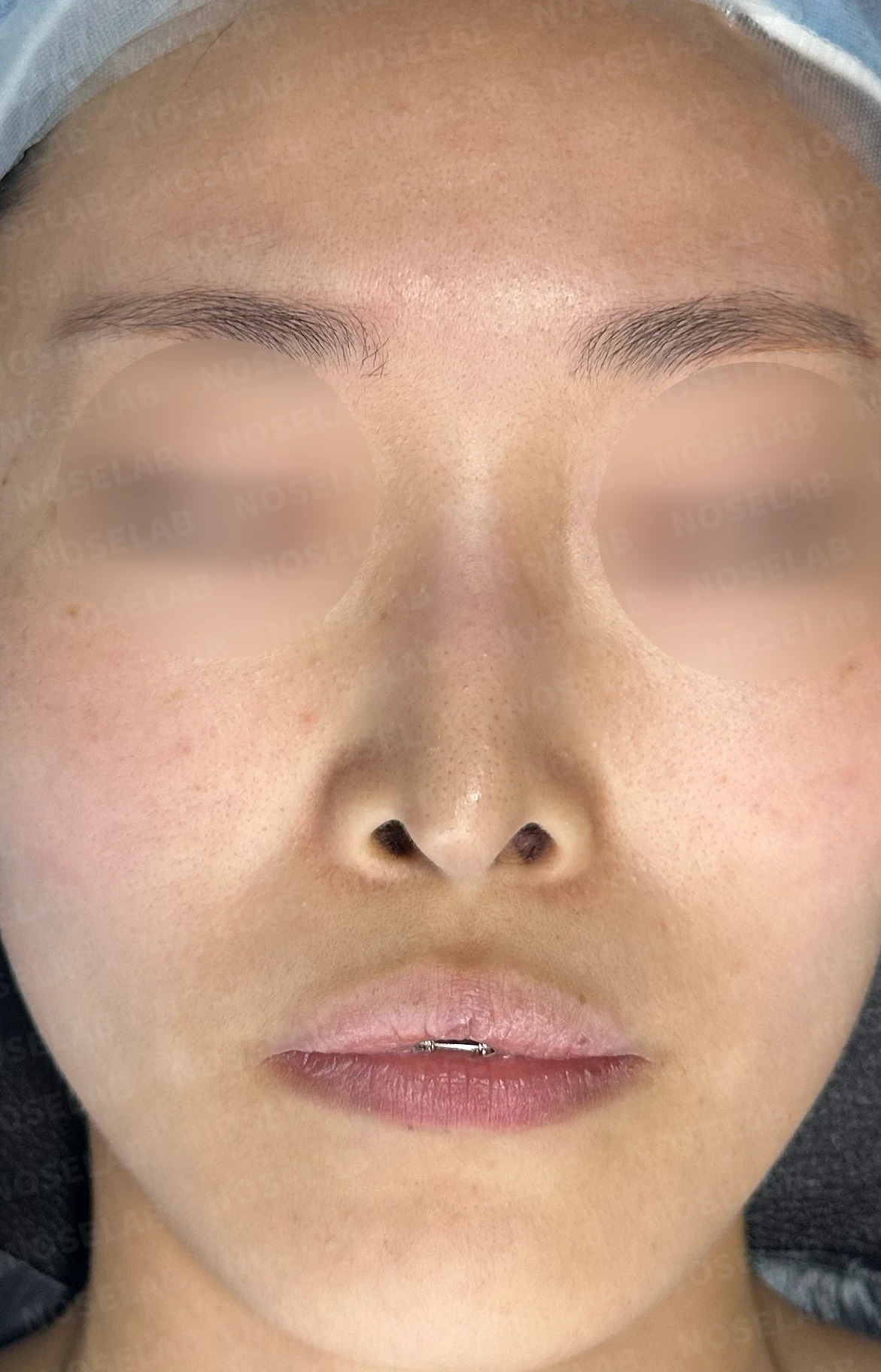 피부가 얇고 작은 들창코의 비대칭과 기능 교정 방법 — 수술 전 / 수술 직후 0일 직후 사진은 부기가 있는 상태로 최종 결과와 다를 수 있습니다.