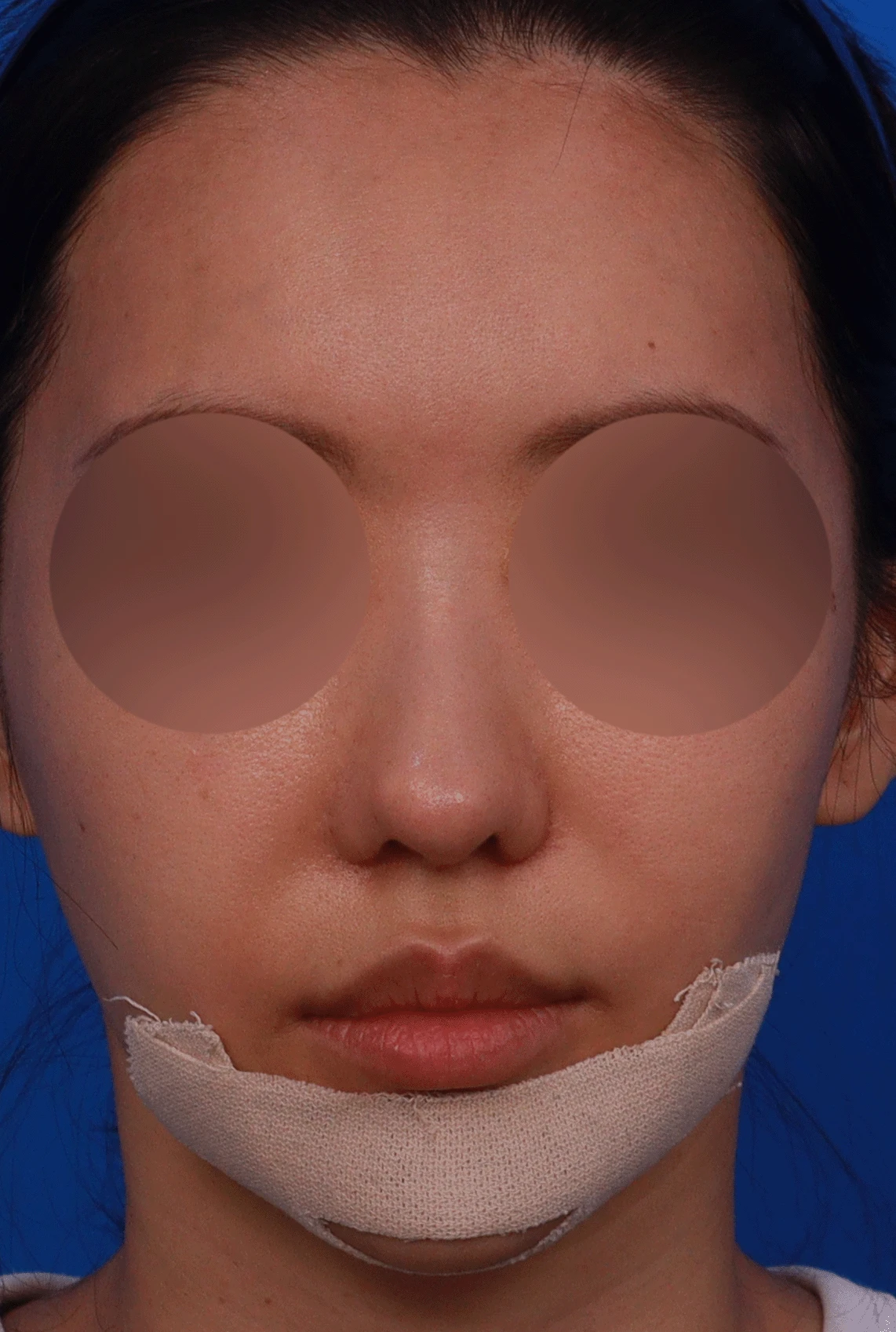 14년간 7차례 수술 후 비중격천공과 복잡한 코끝 문제 해결 - 자가늑연골 재건 실제 후기 — 디자인 상담 정면, 비스듬한 측면, 좌측 측면 사진입니다.