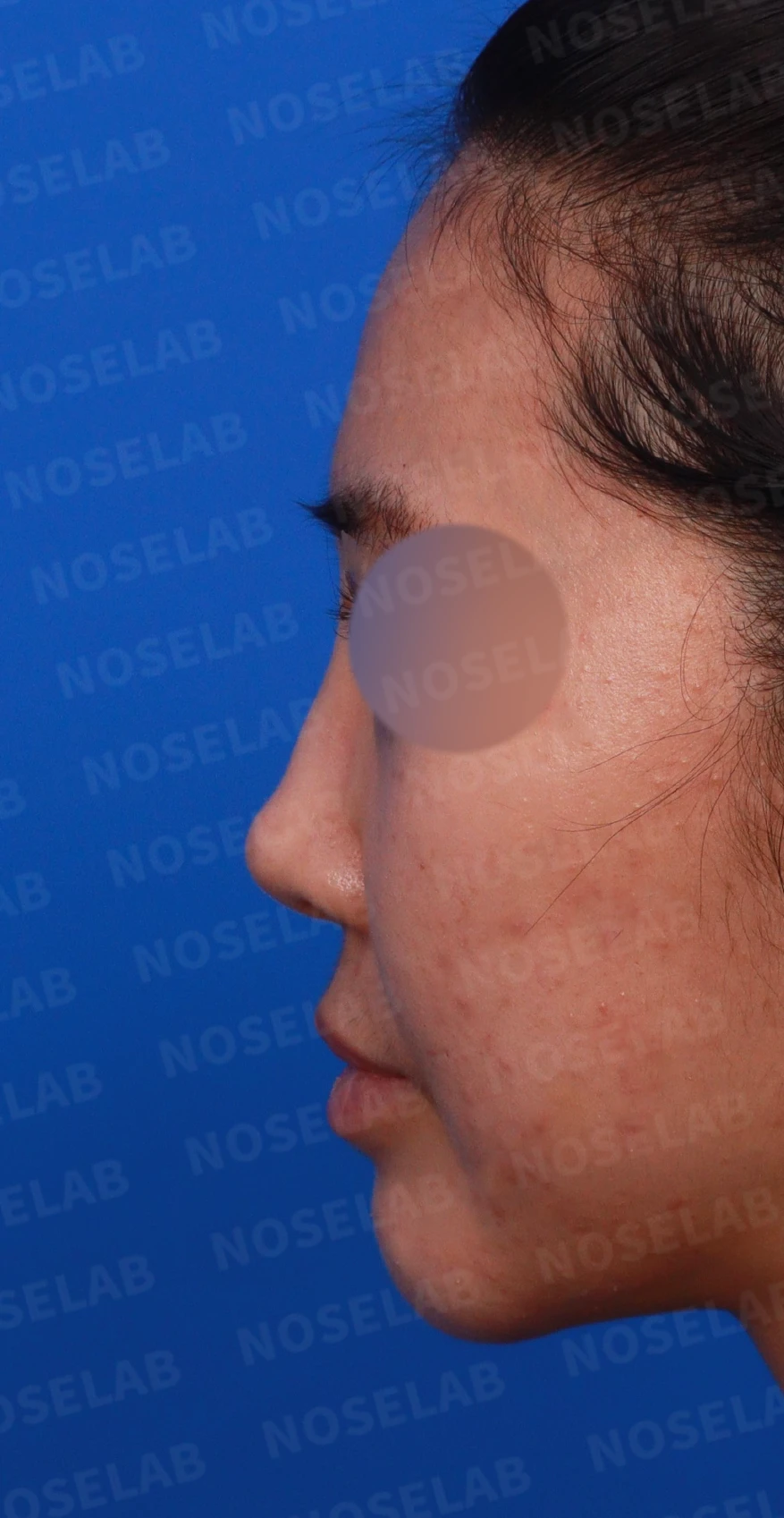코필러 제거, 코막힘 해결 사례 — 디자인 상담 정면, 좌측 측면, 비스듬한 측면 사진