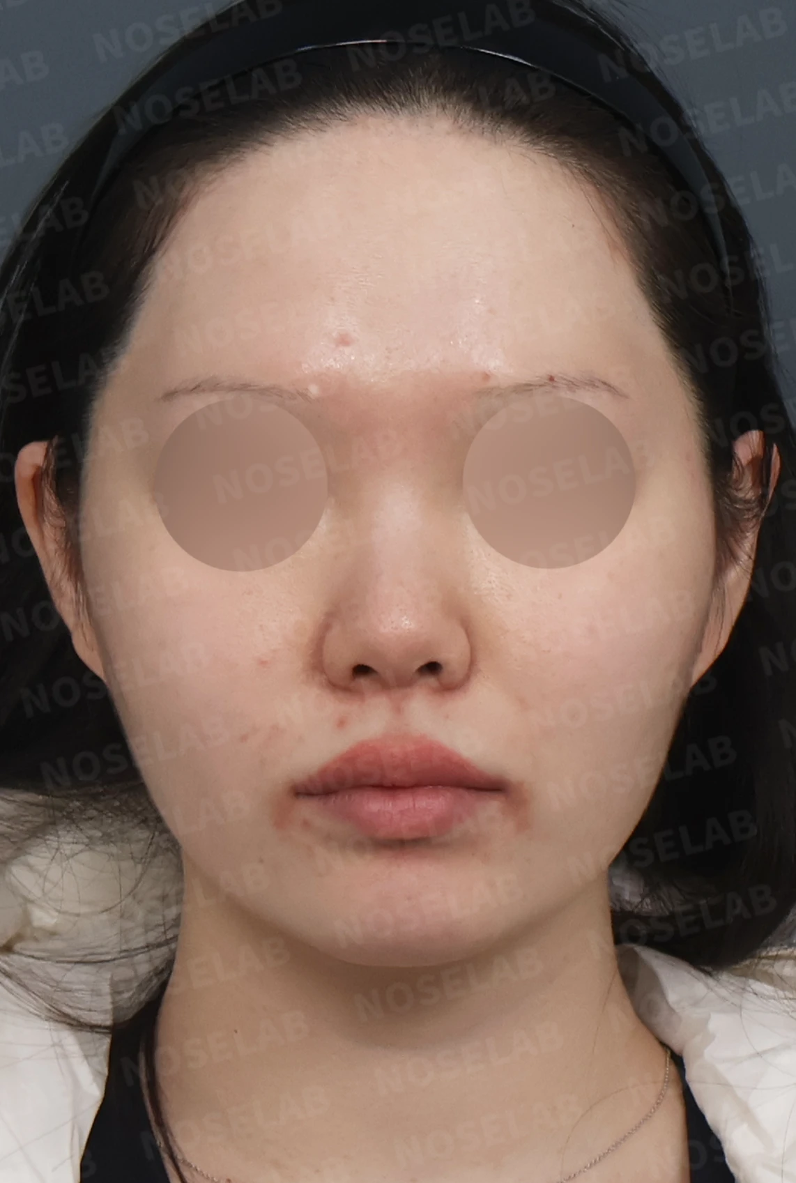 복코와 들린 코끝, 자가늑연골로 여성스러운 직반라인 완성 — 디자인 상담 정면, 좌측 측면, 비스듬한 측면 사진입니다.