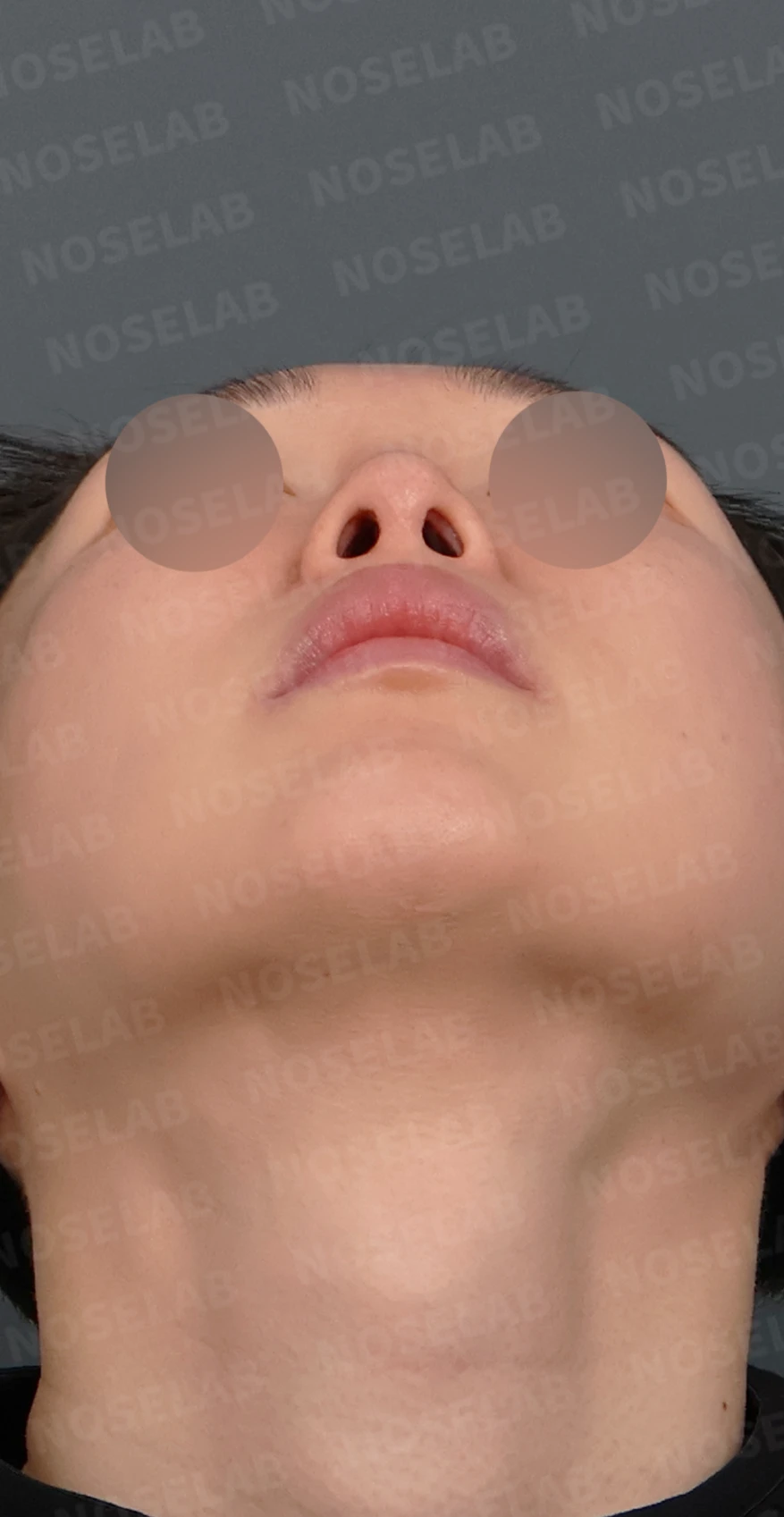 실리콘이 휘고 코가 길어 보이는 이유, 보형물 교체와 늑연골 재건은 어떻게 하나 — 디자인 상담 우측 측면, 비스듬한 측면, 비공 사진입니다.