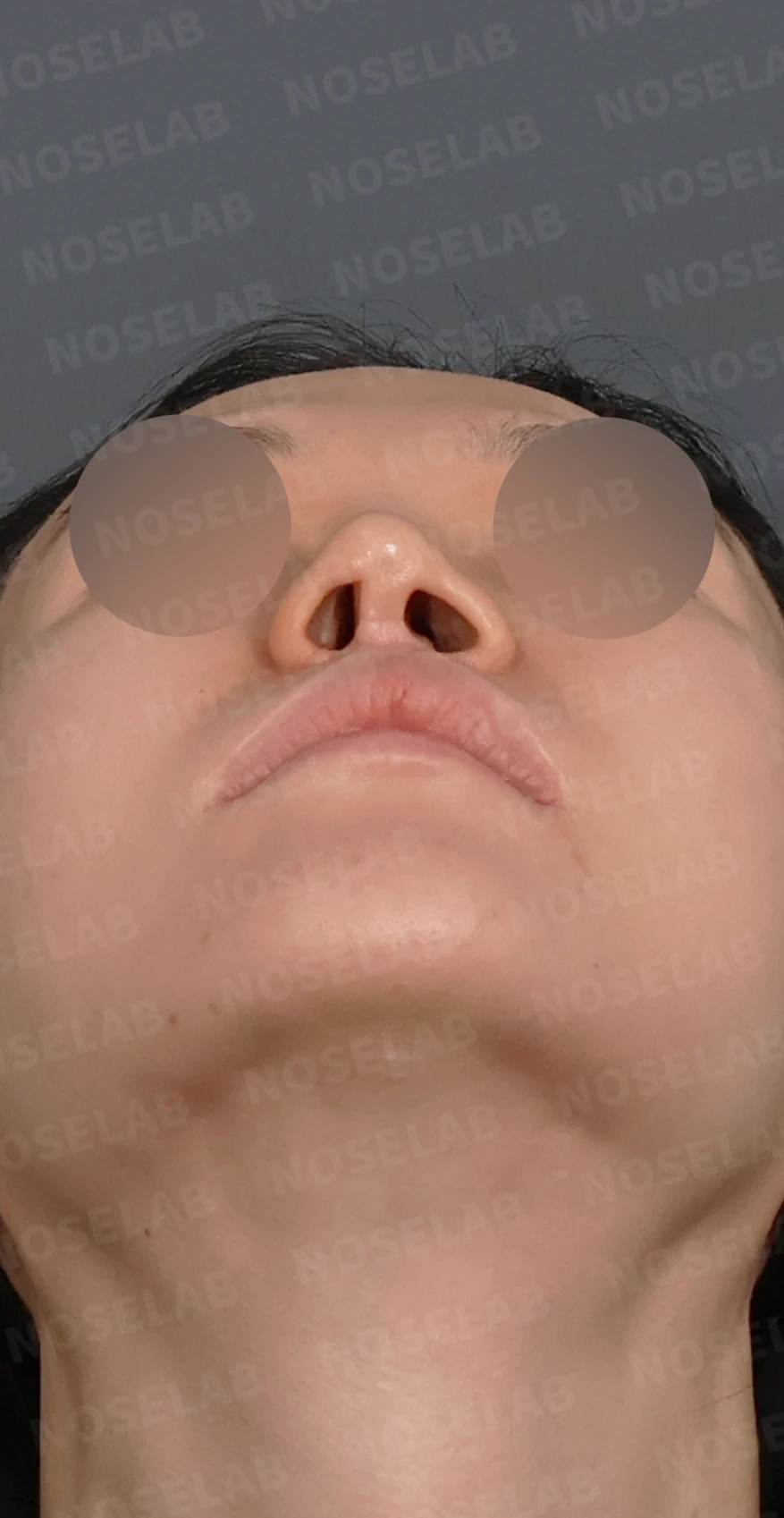 콧구멍 좌우가 심하게 달라 보이는 이유, 연골 재건과 피부이식 교정은 어떻게 하나 — 디자인 상담 우측 측면, 비스듬한 측면, 비공 사진입니다.