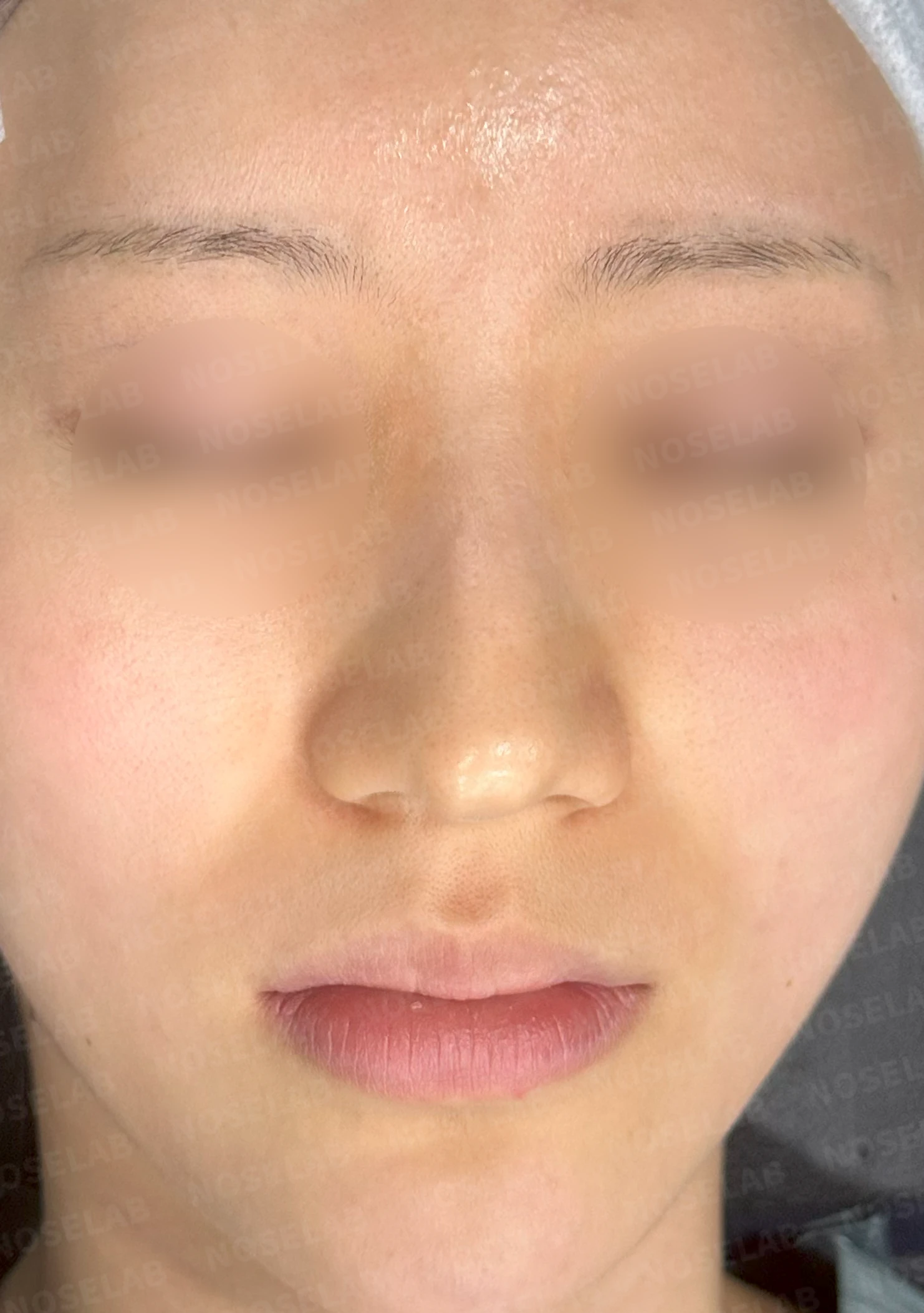 매부리코와 긴 코에 코막힘이 겹치는 이유, 교정은 어떻게 하나 — 수술 전 / 수술 직후 0일 직후 사진은 부기가 있는 상태로 최종 결과와 다를 수 있습니다.
