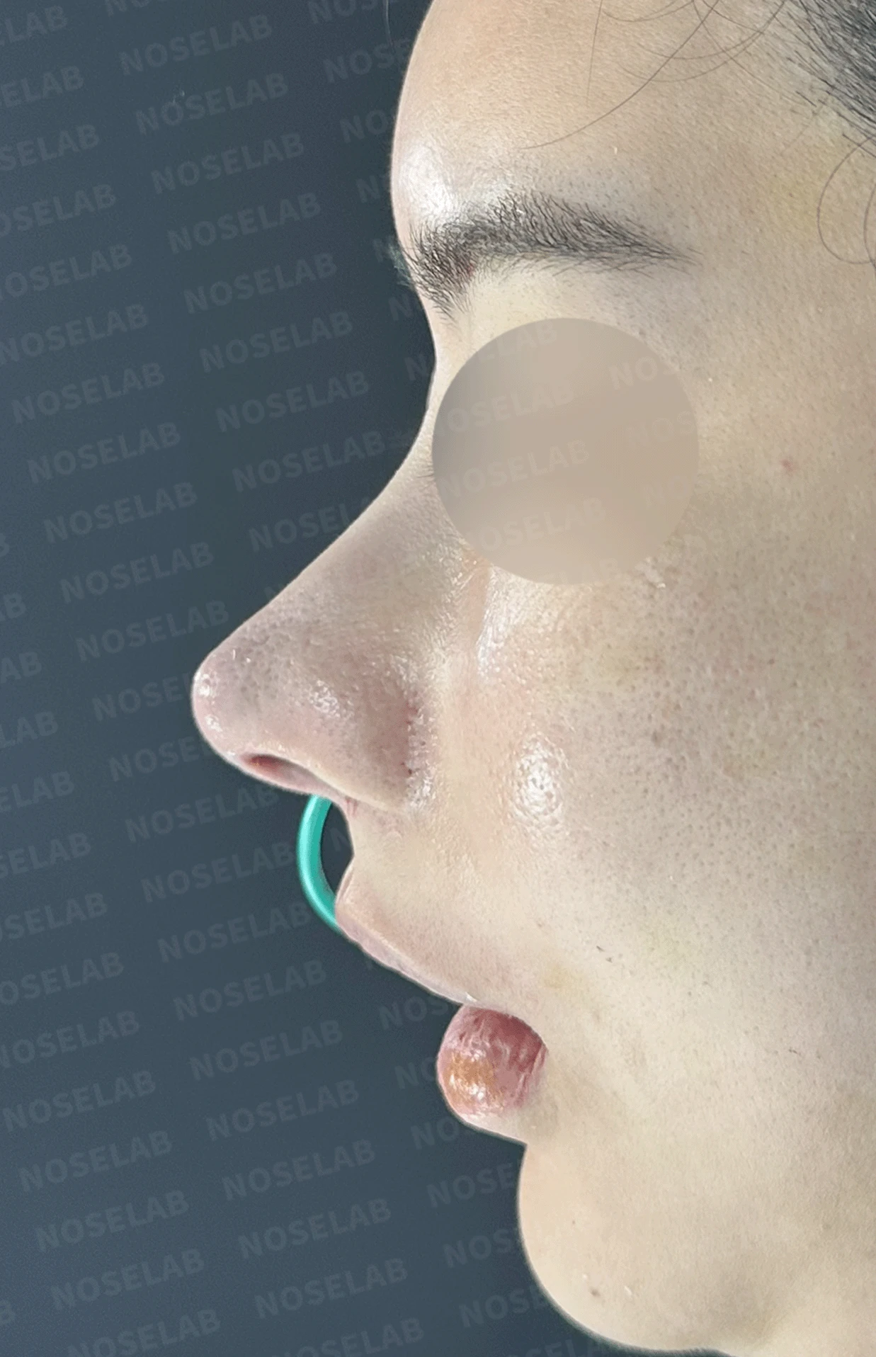 코가 과하게 높아져 부자연스러워 보이고 휘는 이유, 재건은 어떻게 하나 — 수술 전 / 수술 직후 0일 직후 사진은 부기가 있는 상태로 최종 결과와 다를 수 있습니다.