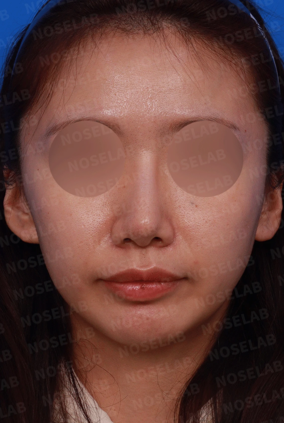 코끝 고어텍스가 문제를 일으키는 이유와 늑연골 비중격 재건 방법 — 디자인 상담 정면, 좌측 측면, 비스듬한 측면 사진입니다.