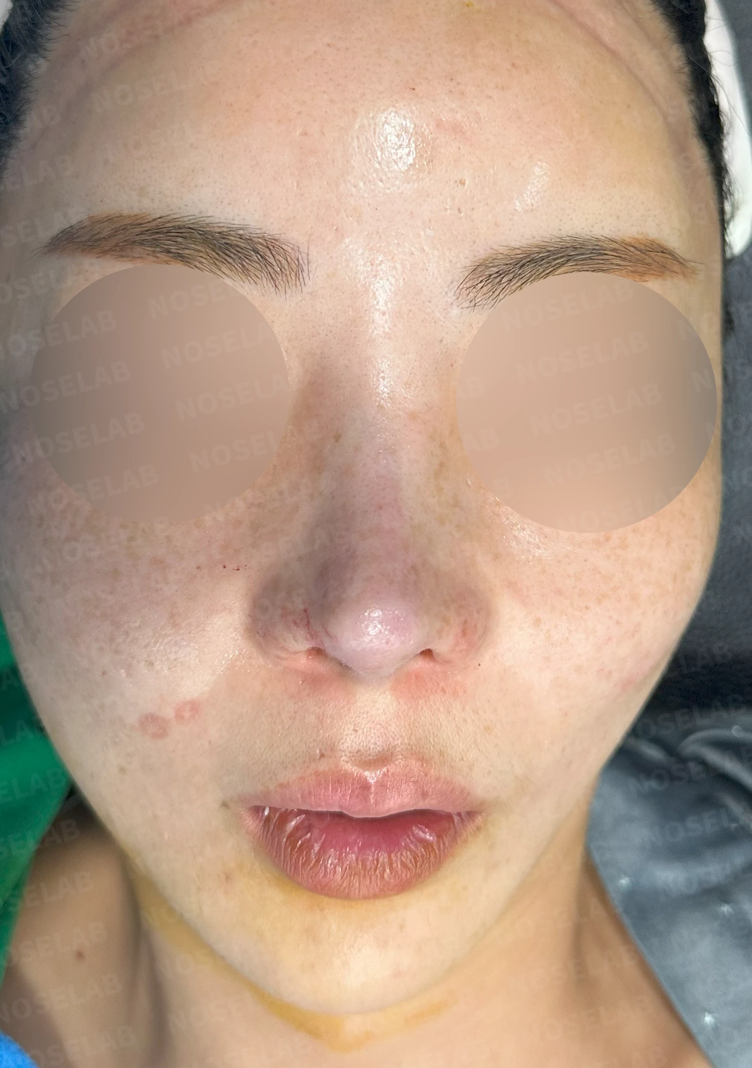 들린 코에서 콧구멍이 삼각형으로 드러나는 이유, 비공 모양 교정은 어떻게 하나 — 수술 직후 0일 정면, 비스듬한 측면, 측면 사진 직후 사진은 부기가 있는 상태로 최종 결과와 다를 수 있습니다.