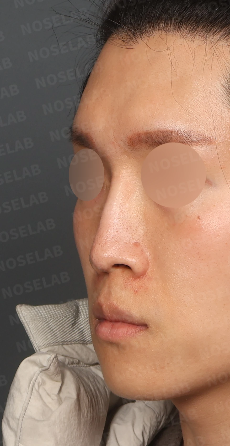 2차 코재수술, 자가늑연골로 비중격 재건과 직선 코 라인 완성 — 디자인 상담 정면, 좌측 측면, 비스듬한 측면 사진