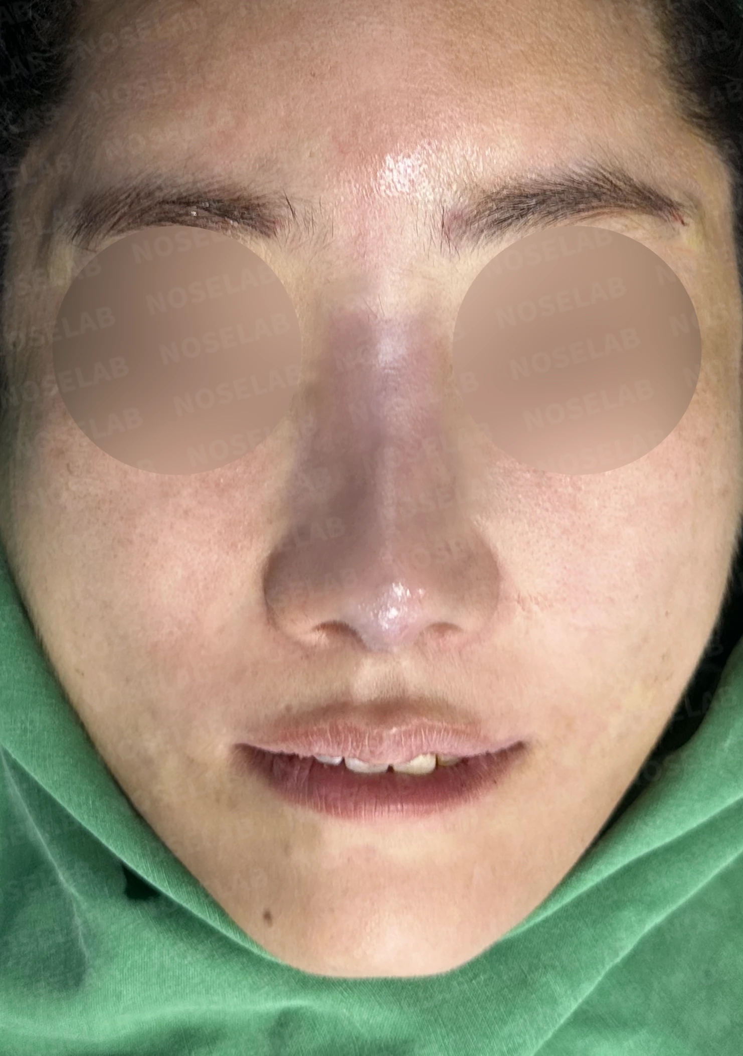콧대에 주입한 불법 시술 이물질, 제거와 비중격 전체 재건은 어떻게 하나 — 수술 직후 0일 정면, 비스듬한 측면, 측면 사진입니다. 직후 사진은 부기가 있는 상태로 최종 결과와 다를 수 있습니다.