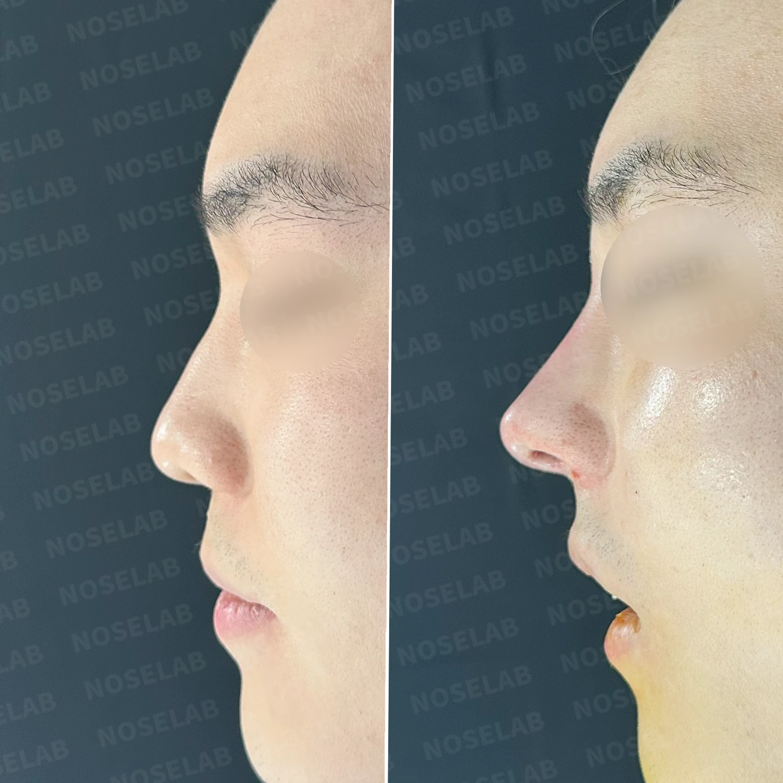 코 실 시술과 지방이식 후 라인이 잡히지 않는 이유, 제거와 늑연골 재건은 어떻게 하나 — 본문 사진 22