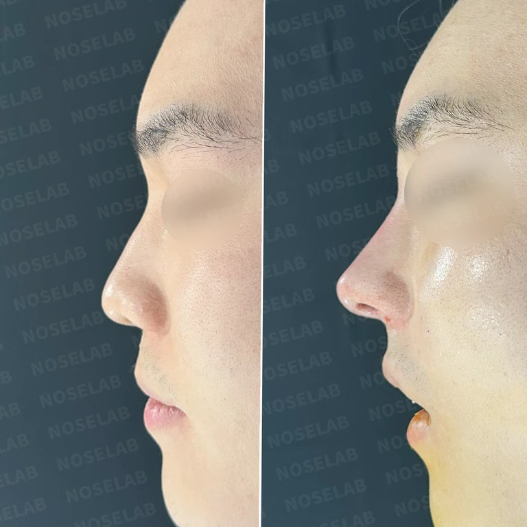 [코성형 후기] 코높이기 & 코막힘 개선 - 실 제거 후 자연스러운 라인 만들기 — 전후 비교