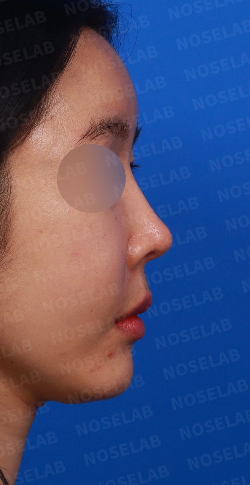 코가 들리고 콧기둥이 꺼지며 코끝이 찝혀 보이는 이유, 복합 교정은 어떻게 하나 — 디자인 상담 우측 비스듬한 측면,측면, 비공 사진