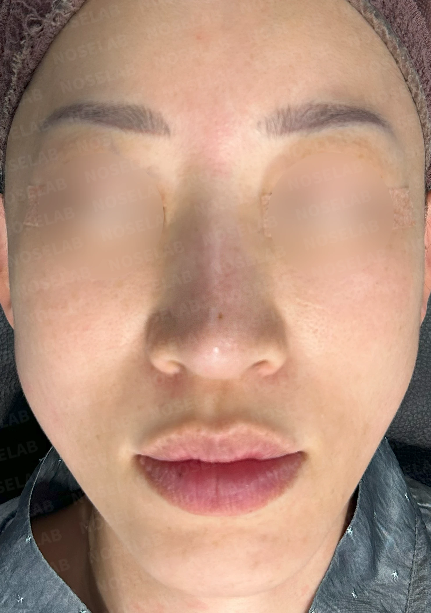 충격을 받은 뒤 코끝에서 소리가 나고 모양이 달라지는 이유와 늑연골 재건 — 수술 전 / 수술 직후 0일 직후 사진은 부기가 있는 상태로 최종 결과와 다를 수 있습니다.