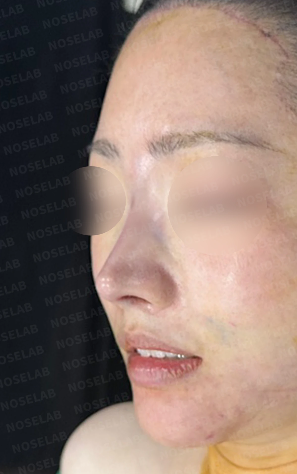 재수술한 코가 휘어 보이고 코끝이 처지는 이유 — 수술 전 / 수술 직후 0일 직후 사진은 부기가 있는 상태로 최종 결과와 다를 수 있습니다.