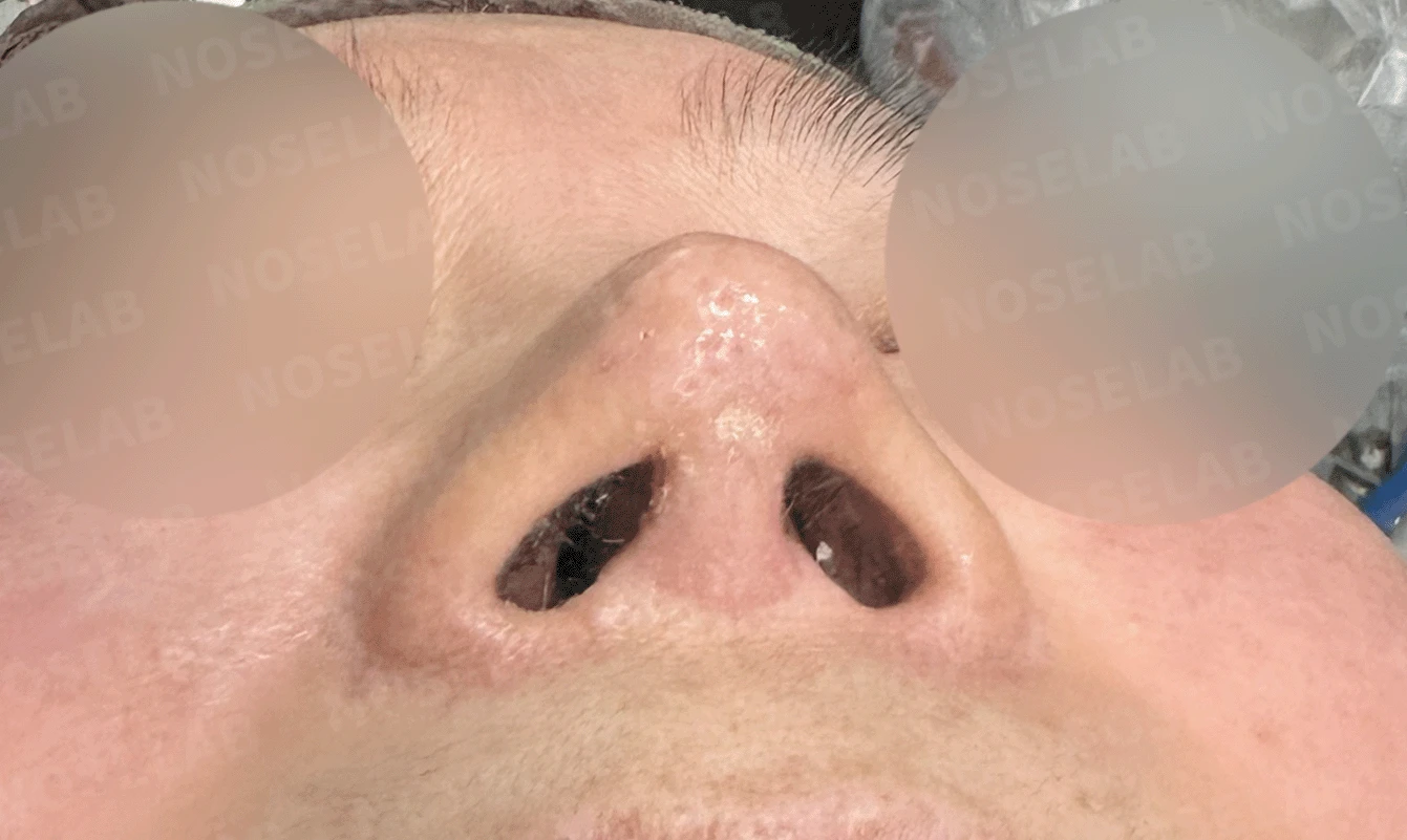 오래된 코 보형물과 코 통증, 재수술에서 확인할 점 — 본문 사진 13
