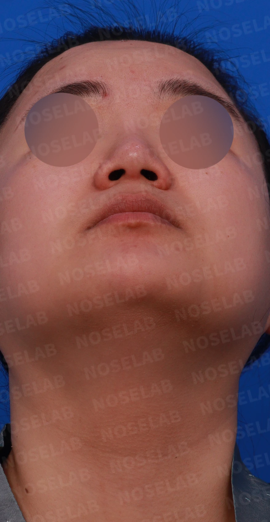 코에 삽입된 매선을 제거하고 재건하는 방법 — 디자인 상담 우측 측면, 비스듬한 측면, 비공 사진입니다.