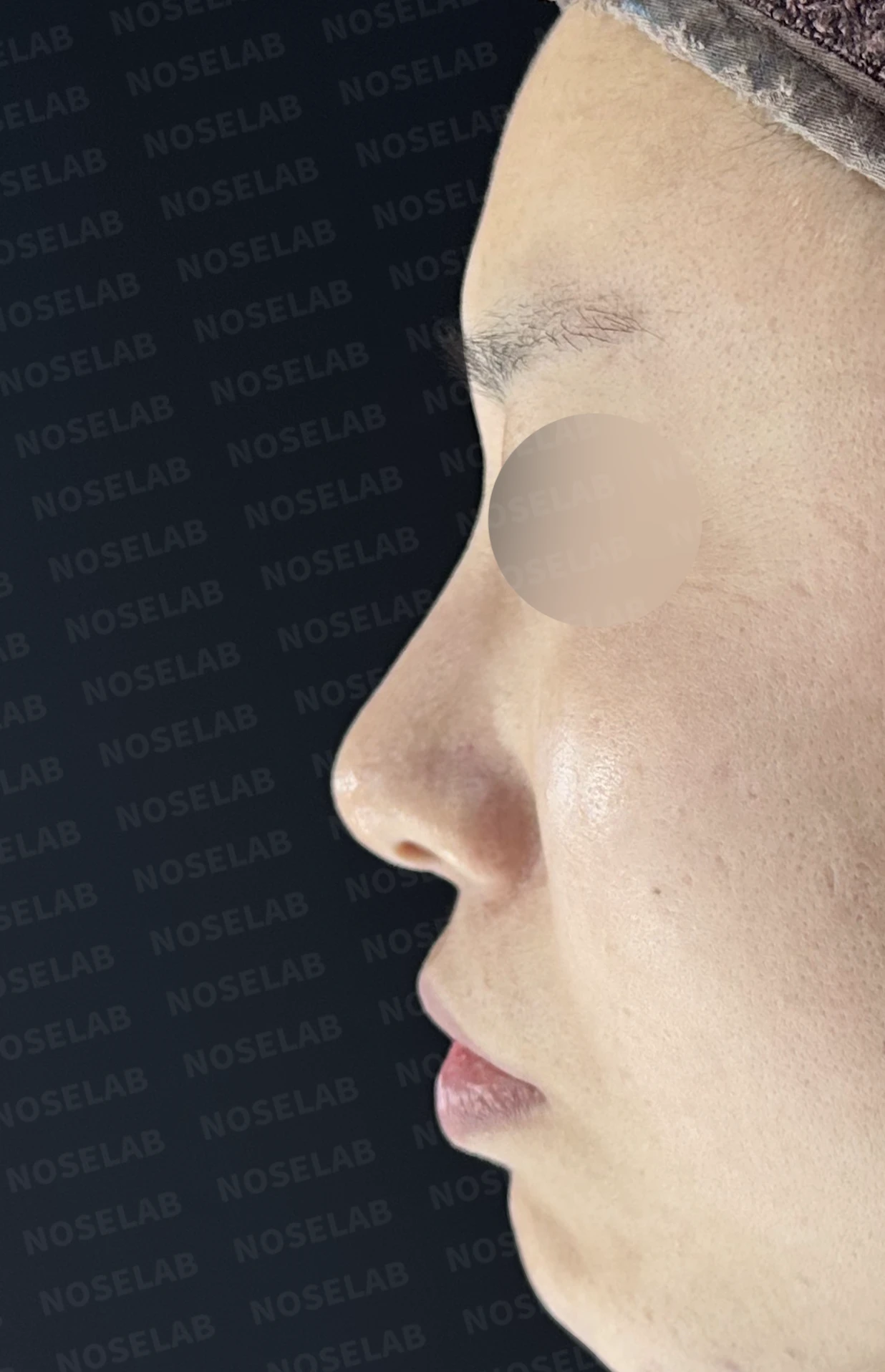 비공 비대칭과 휘어진 코, 자가늑연골 재건으로 교정한 코재수술 — 전(좌) 직후(후)