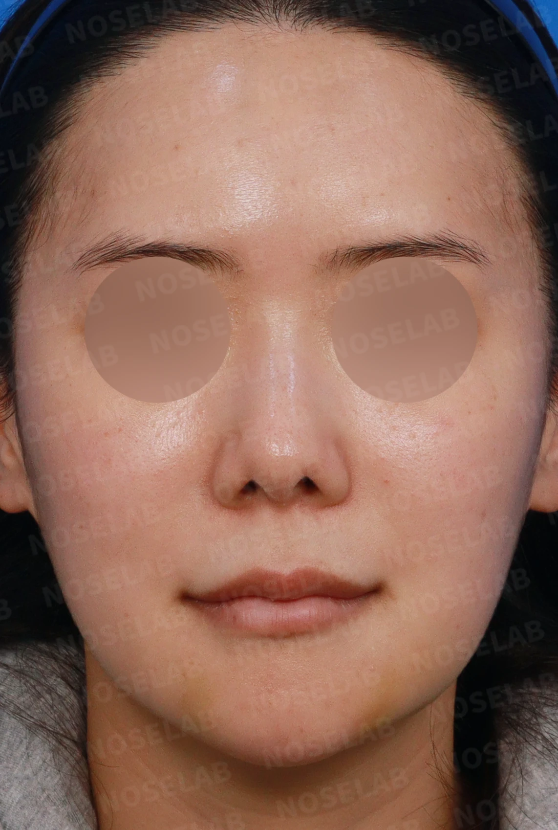 들린 코와 한쪽만 찝힌 콧구멍이 생기는 이유, 무보형물 재건은 어떻게 하나 — 디자인 상담 정면, 좌측 측면, 비스듬한 측면 사진입니다.