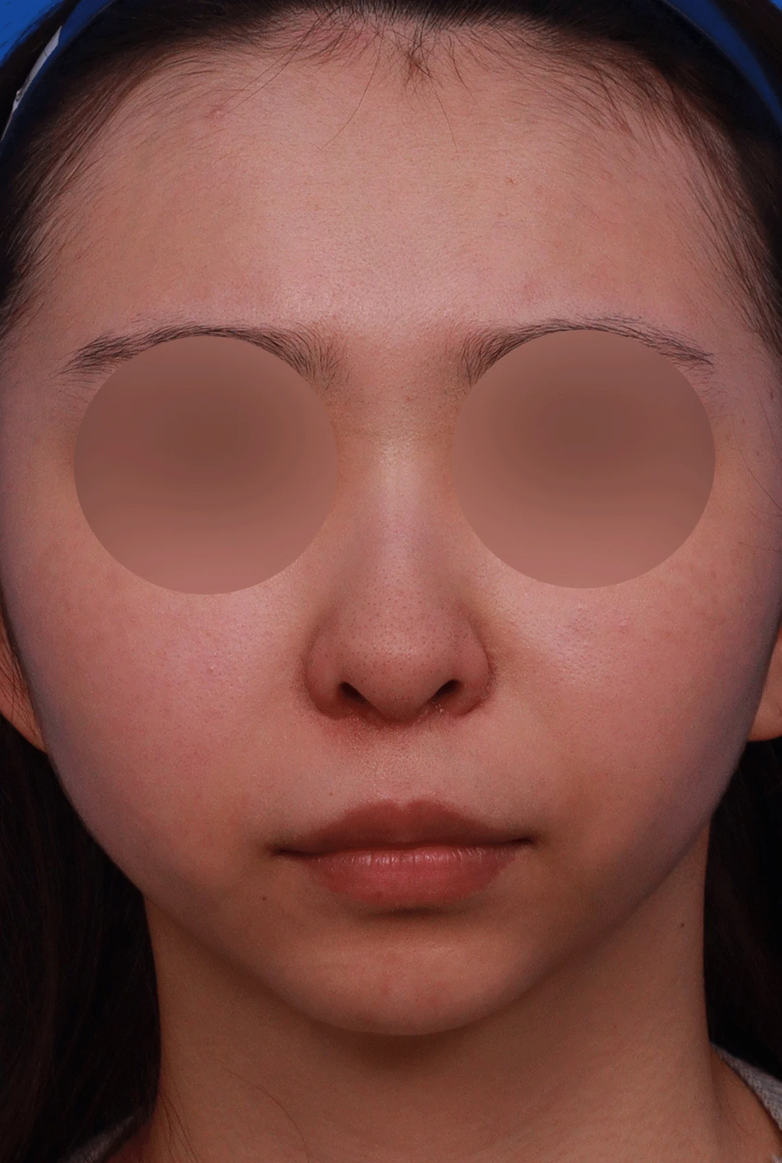 여러 번 수술해도 콧대가 낮고 복코가 남는 이유, 늑연골 재건과 얼굴 균형 — 디자인 상담 정면 , 좌측 비스듬한 측면 , 측면 사진입니다.