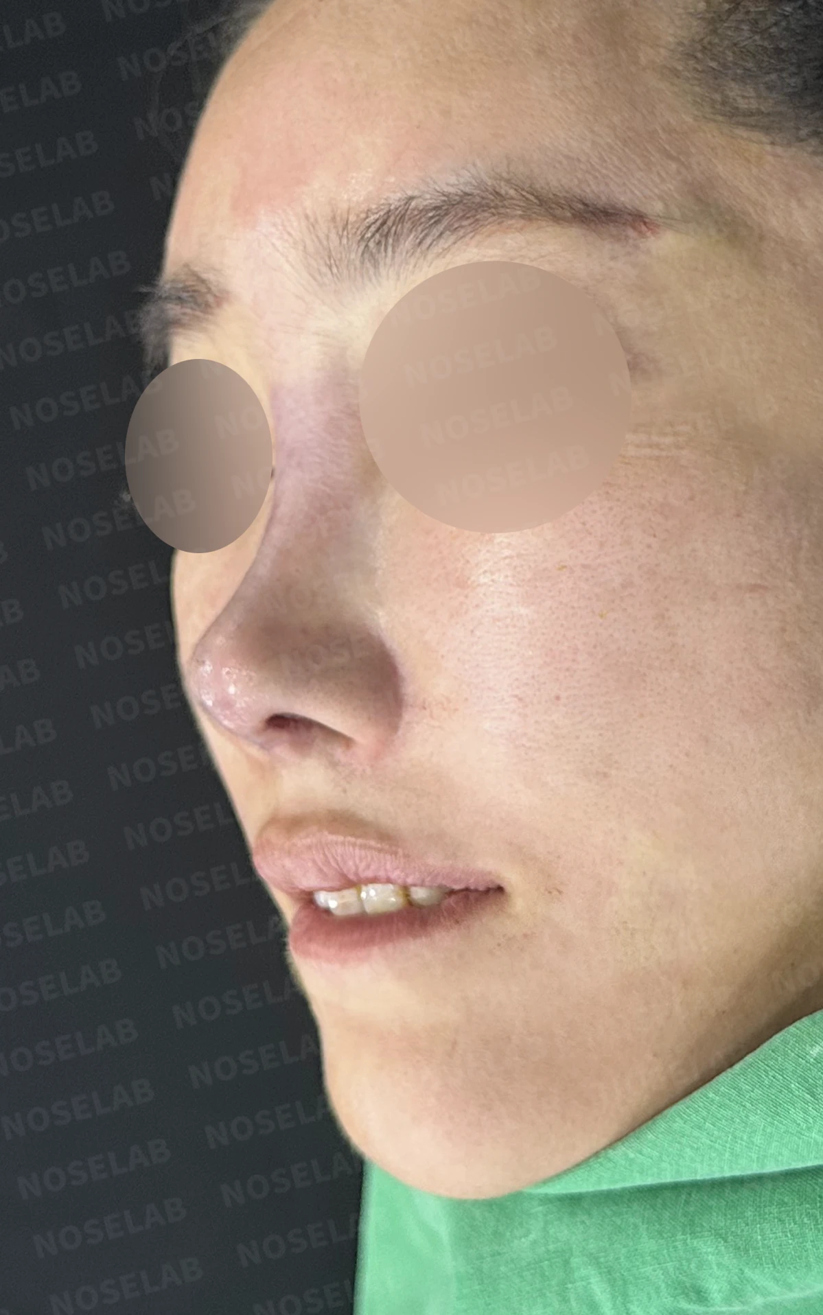 콧대에 주입한 불법 시술 이물질, 제거와 비중격 전체 재건은 어떻게 하나 — 수술 직후 0일 정면, 비스듬한 측면, 측면 사진입니다. 직후 사진은 부기가 있는 상태로 최종 결과와 다를 수 있습니다.