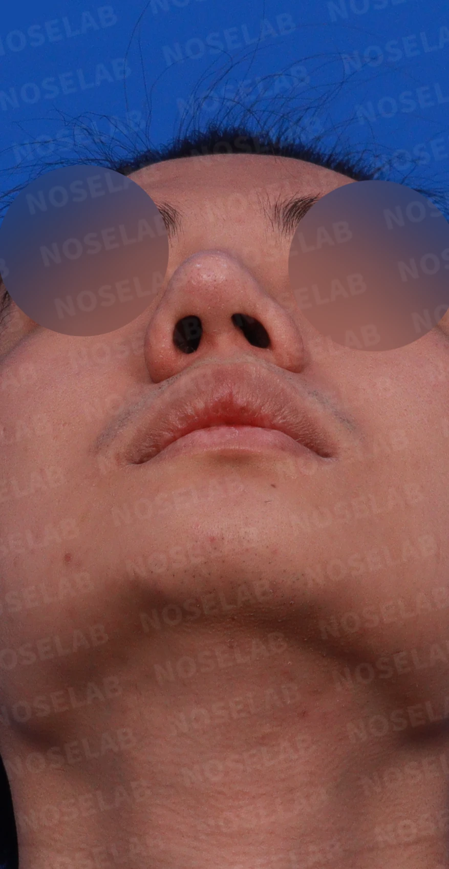 코뼈 골절에 미용 수술을 함께 할 수 있는 경우와 단계로 나누는 방법 — 디자인 상담 우측 비스듬한 측면, 측면, 비공 사진
