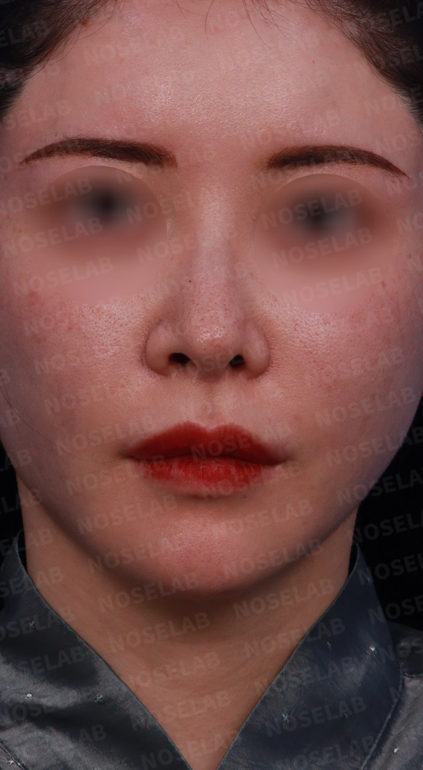 코막힘, 콧구멍비대칭 교정 사례 — 수술전 디자인 정면, 좌측 비스듬한 측면, 측면