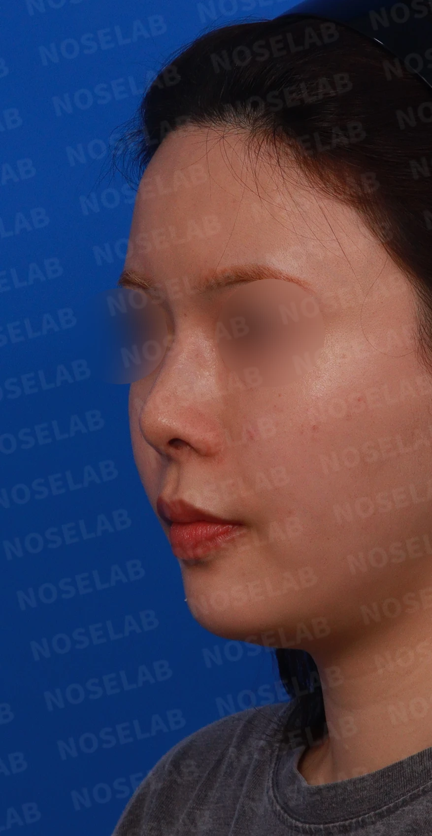 고개를 들면 콧구멍 모양이 다르고 코가 막히는 이유, 비중격 재건 방법 — 디자인 상담 정면 , 좌측 측면 , 비스듬한 측면 사진입니다.