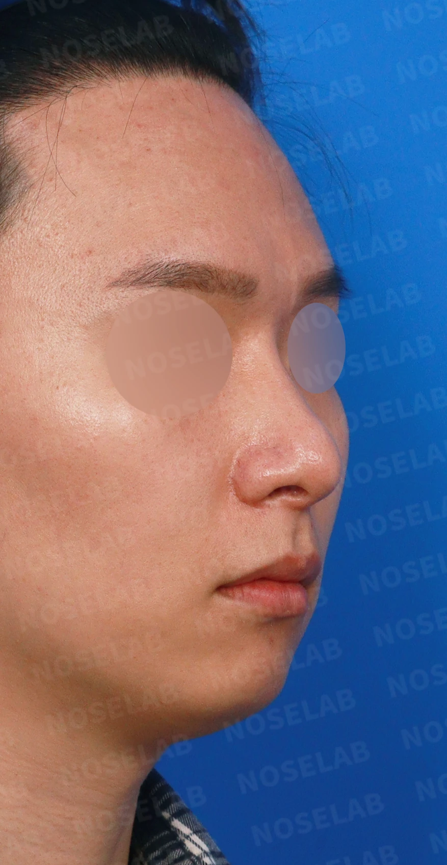 한쪽 비골이 함몰되면 왜 코가 휘어 보이는가, 절골 복원과 비중격 재건 — 디자인 상담 우측 측면, 비스듬한 측면, 비공 사진