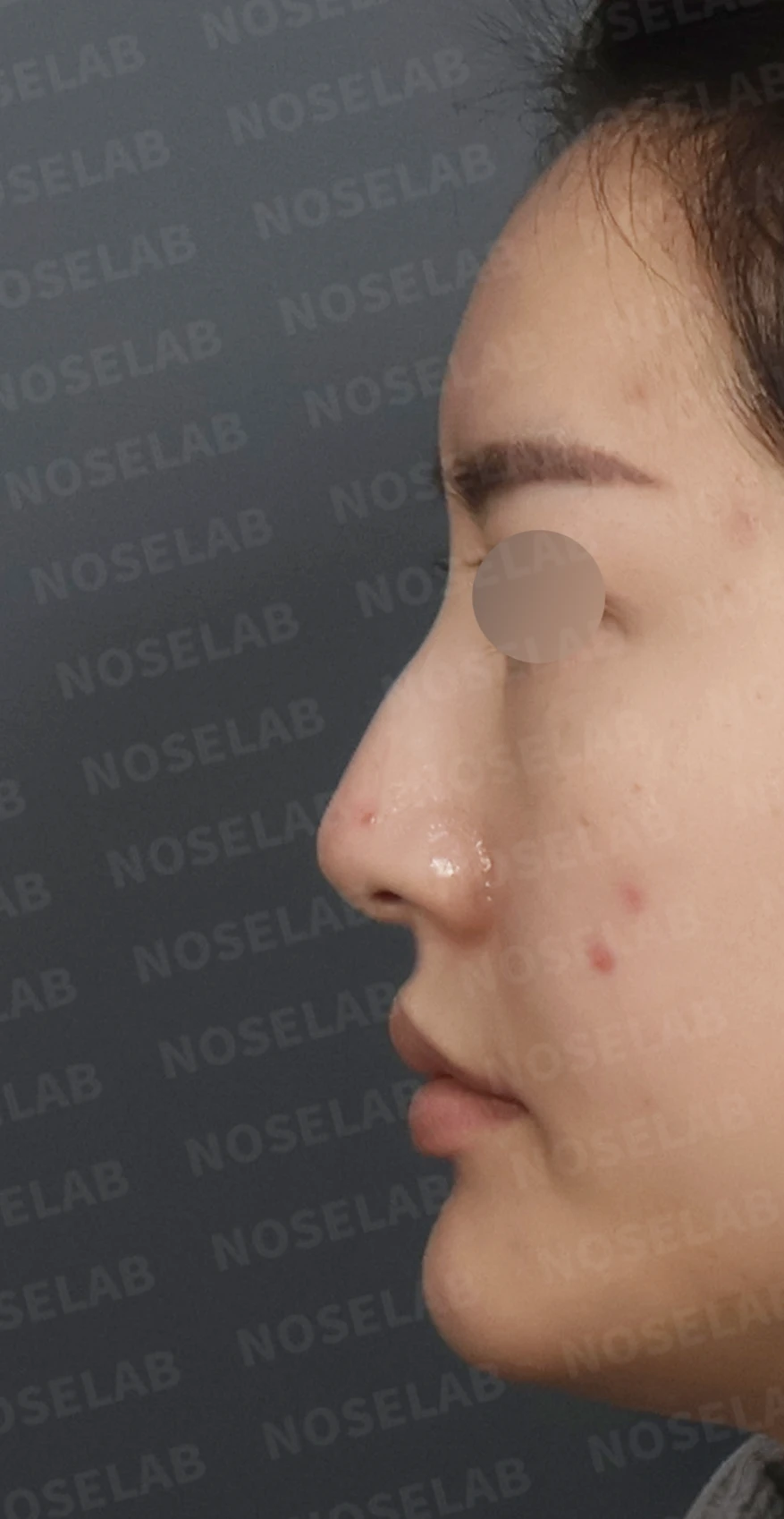 매부리코 교정, 자가늑연골로 자연스러운 코 라인 완성 — 디자인 상담 정면, 좌측 측면, 비스듬한 측면 사진입니다.