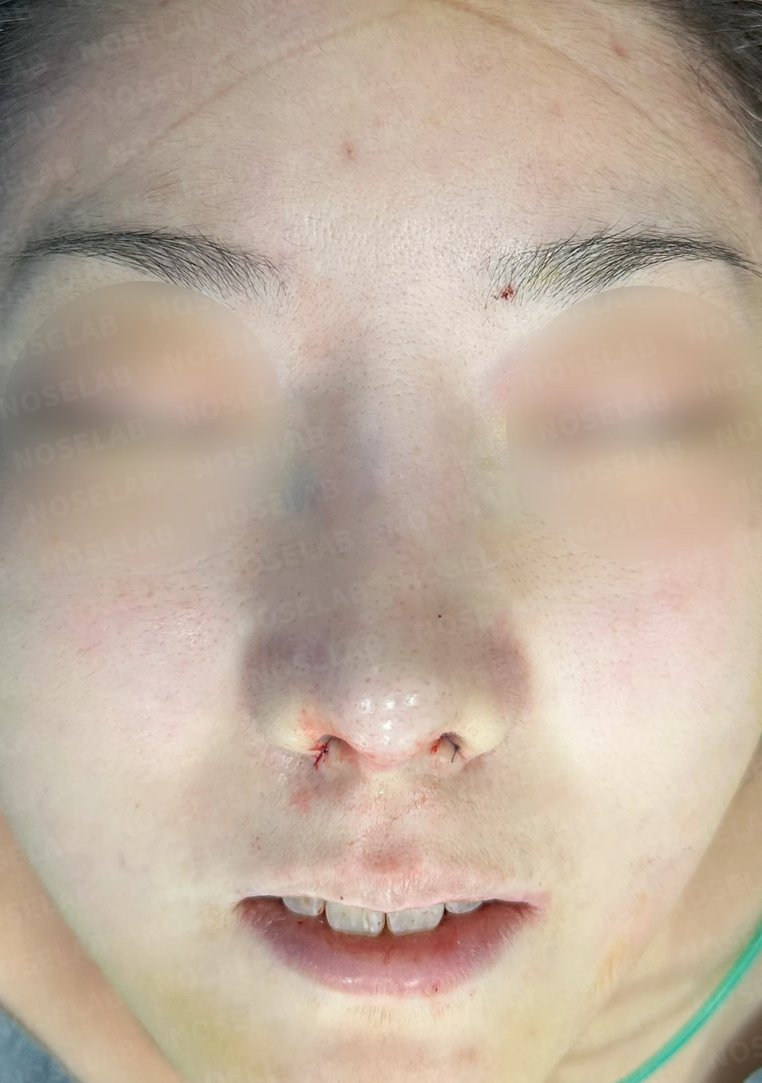 코재수술 뒤 콧대가 붉어 보이는 이유와 재건 방법 — 수술 직후 0일 정면, 측면, 비스듬한 측면 사진입니다. 직후 사진은 부기가 있는 상태로 최종 결과와 다를 수 있습니다.