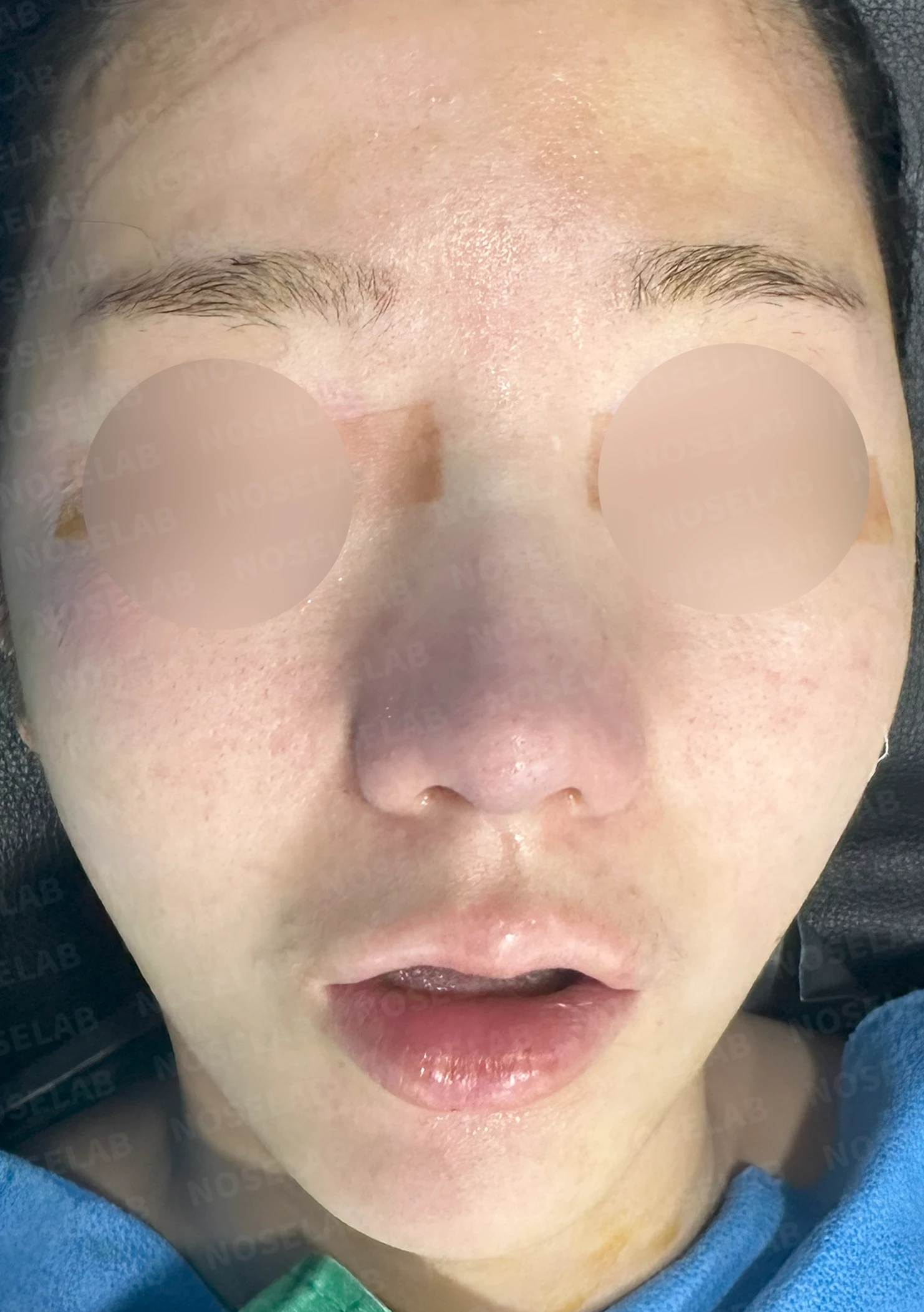 비중격 연골이 손상되면 코끝이 처지고 비주가 함몰되는 이유 — 본문 사진 8