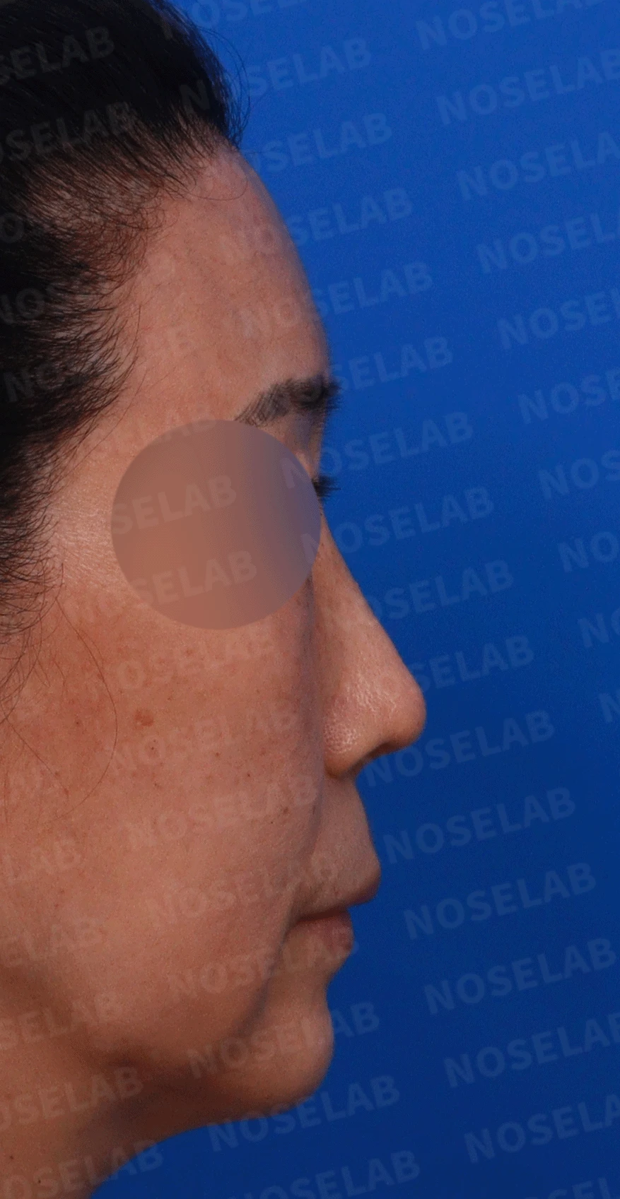 여러 차례 수술에도 코가 계속 휘는 이유, 비중격 연골 재건 방법 — 디자인 상담 우측 측면 , 비스듬한 측면 , 비공 사진입니다.