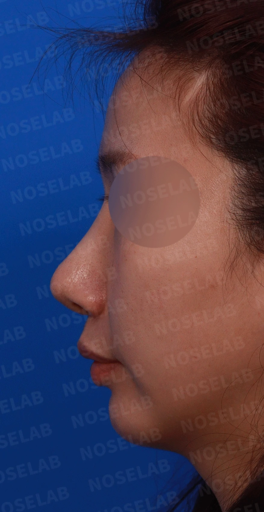 코끝 고어텍스가 문제를 일으키는 이유와 늑연골 비중격 재건 방법 — 디자인 상담 정면, 좌측 측면, 비스듬한 측면 사진입니다.