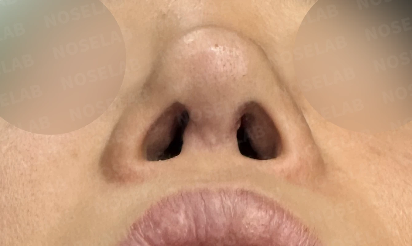 여러 번의 코재수술 뒤 비중격이 무너지는 이유, 자가늑연골 전면 재건은 어떻게 하나 — 수술 전 / 수술 직후 0일 직후 사진은 부기가 있는 상태로 최종 결과와 다를 수 있습니다.