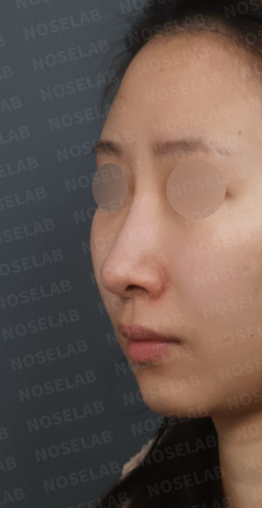 길고 처진 코, 휜코 교정과 코막힘까지 한 번에 해결한 재수술 사례 — 디자인 상담 정면, 좌측 측면, 비스듬한 측면 사진입니다.