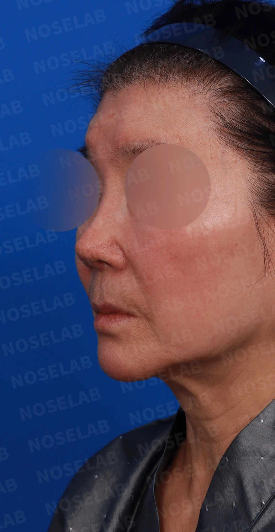 오래된 코 보형물과 코 통증, 재수술에서 확인할 점 — 디자인 상담 정면, 좌측 측면, 비스듬한 측면 사진입니다.