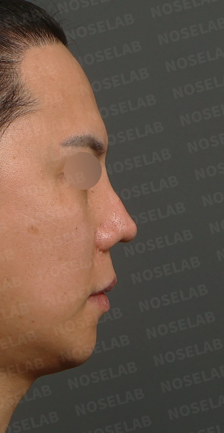 여러 차례 코재수술 후 구축 변형, 자가늑연골로 재건한 사례 — 디자인 상담 우측 측면, 비스듬한 측면, 비공 사진입니다.