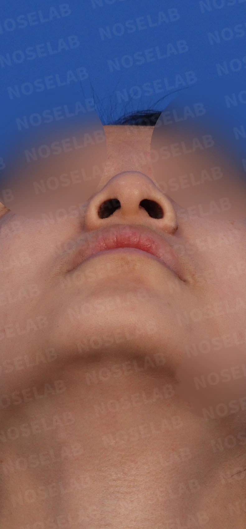 긴 코와 매부리코, 얼굴 비율을 고려한 교정 방법 — 디자인 상담 좌측 비스듬한 측면, 측면, 콧구멍 사진입니다.