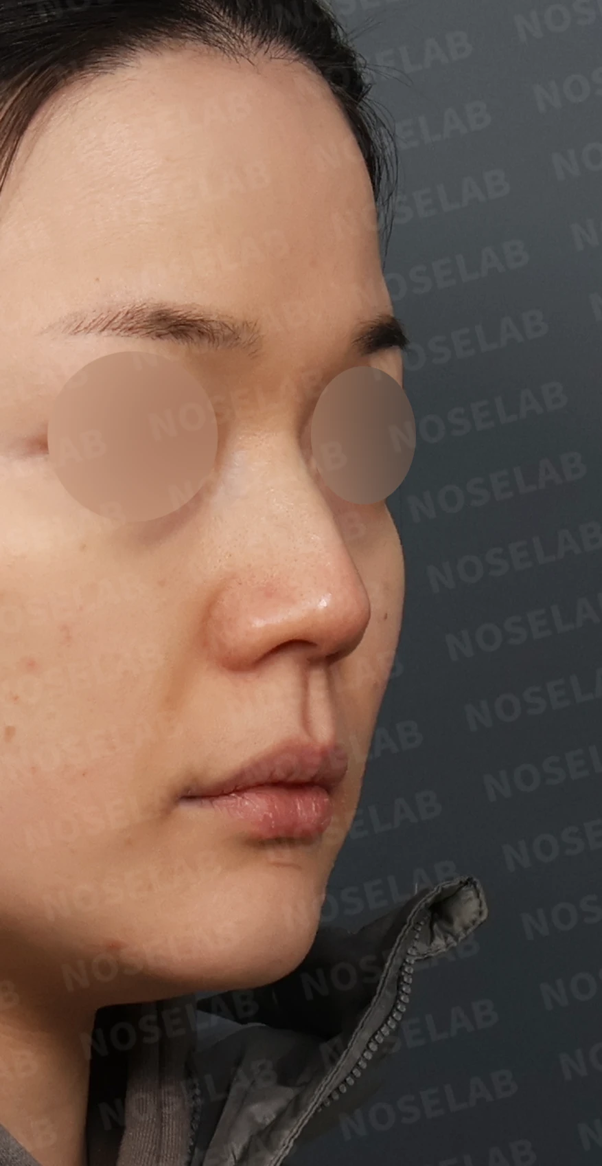 매부리코 교정, 처진 코끝을 오똑하게 바꾸는 비개방 코성형 — 디자인 상담 우측 측면, 비스듬한 측면, 비공 사진입니다.