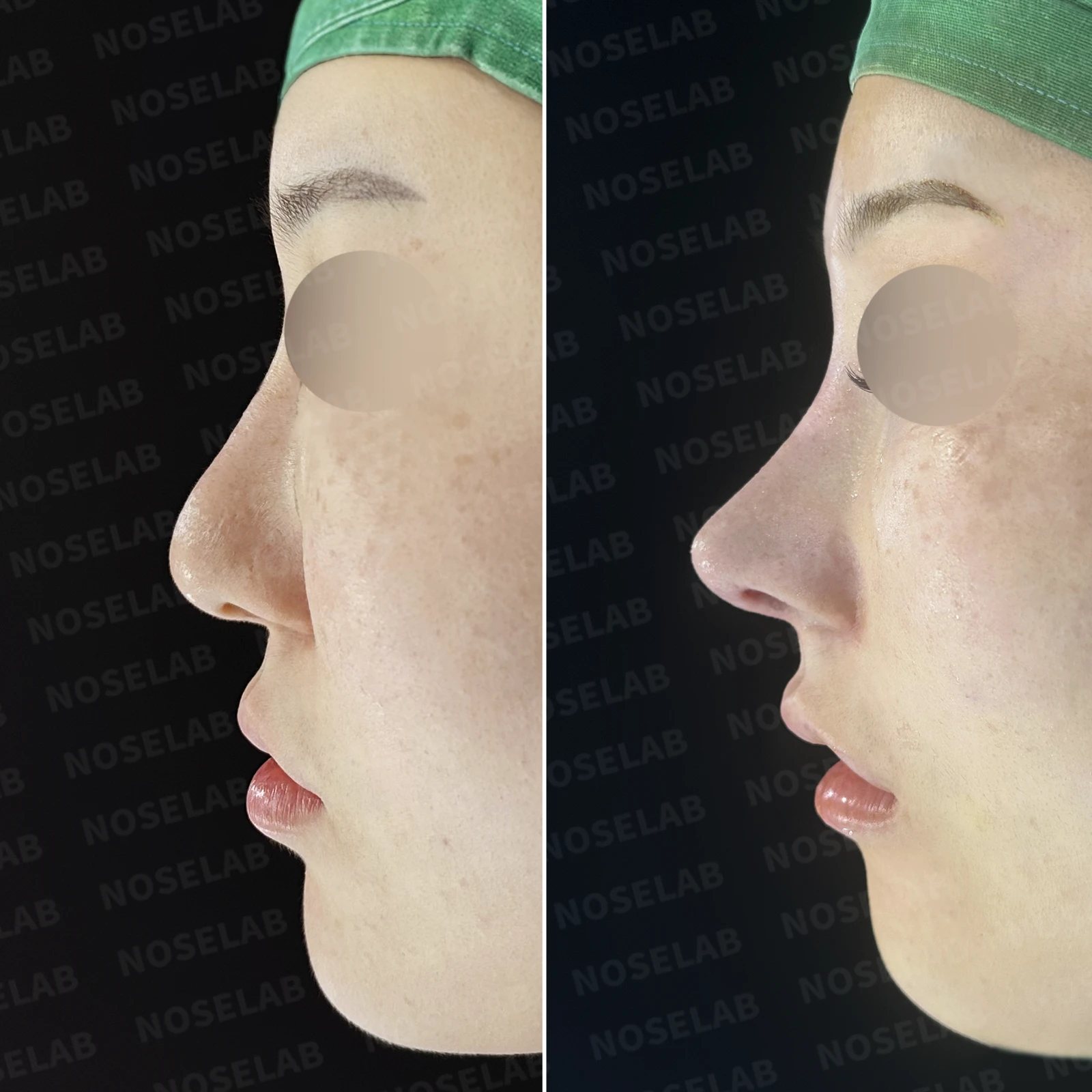 길고 뭉툭한 코, 자가늑연골로 화려하면서 자연스럽게 — 본문 사진 21