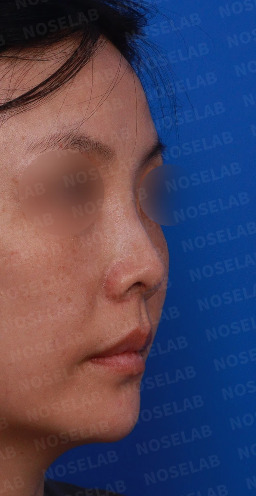 첫 코성형에서 코끝 구조와 콧구멍 노출은 어떻게 다루나 — 디자인 상담 우측 측면 , 비스듬한 측면 , 비공 사진입니다.