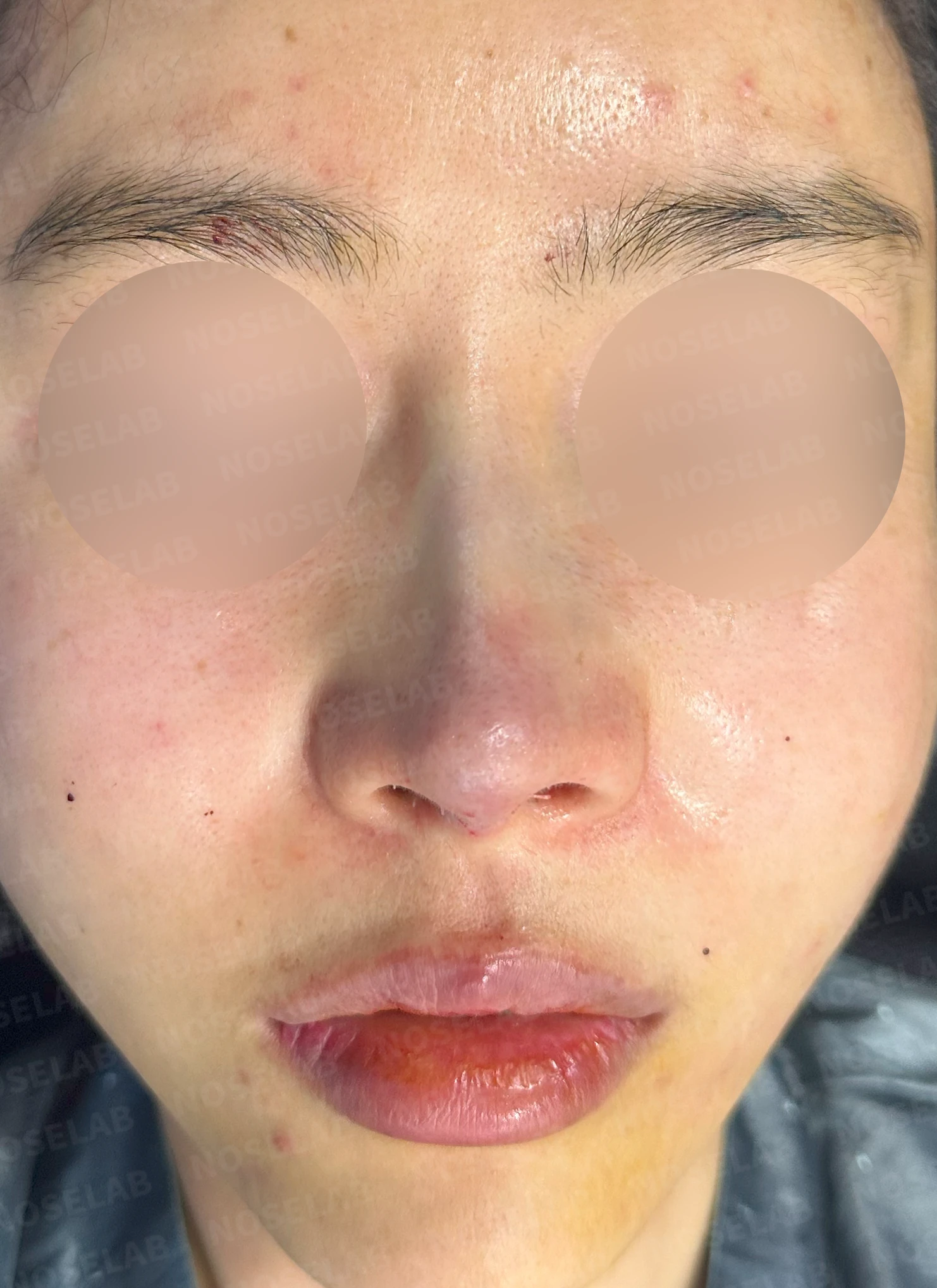 코가 들리고 콧기둥이 꺼지며 코끝이 찝혀 보이는 이유, 복합 교정은 어떻게 하나 — 수술 전 / 수술 직후 0일 직후 사진은 부기가 있는 상태로 최종 결과와 다를 수 있습니다.