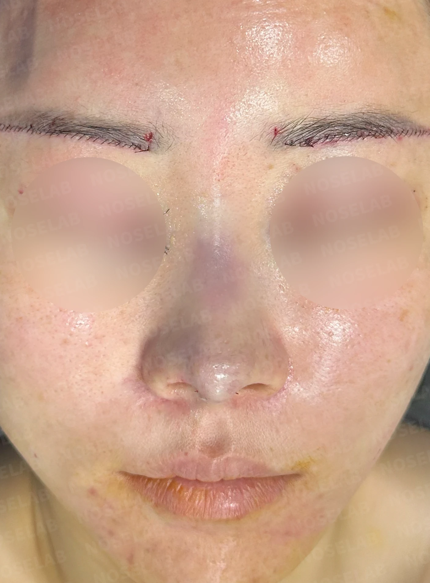 비주 내리기와 비순각 교정을 함께 계획하는 방법 — 수술 직후 0일 정면, 측면, 비슷한 측면 직후 사진은 부기가 있는 상태로 최종 결과와 다를 수 있습니다.