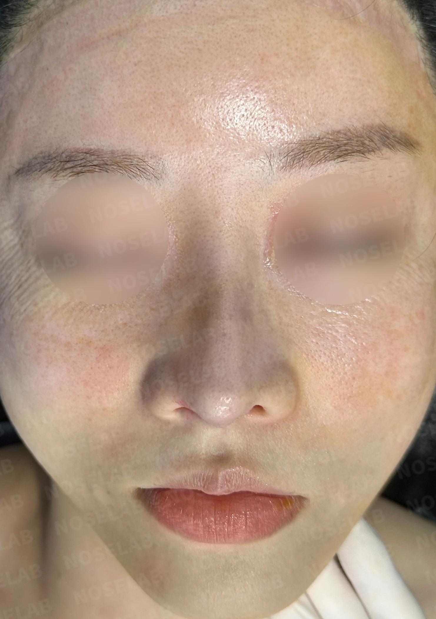 짧고 들린 코를 교정하는 재수술 방법 — 수술 전 / 수술 직후 0일 직후 사진은 부기가 있는 상태로 최종 결과와 다를 수 있습니다.