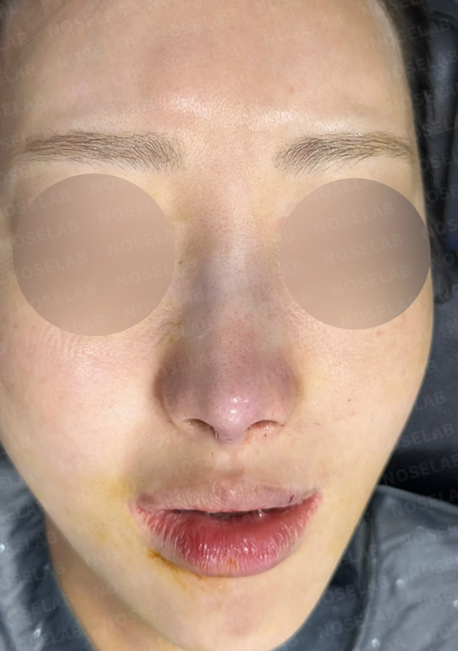 뾰족한 코끝과 연골 비침 - 자가진피 코 재수술 후기 — 직후 정면, 측면, 비스듬한 측면 사진입니다.