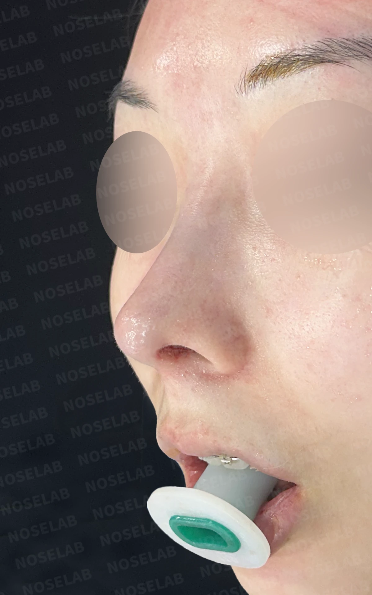 작고 낮은 코, 자가늑연골로 비순각 교정까지 한 번에 완성한 비개방 코성형 — 전(좌) 직후(후)