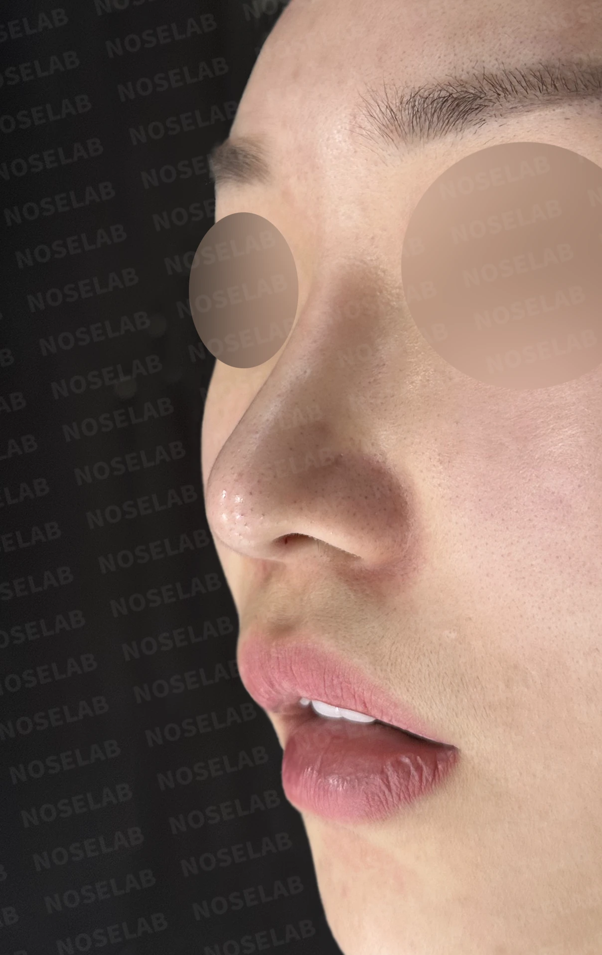 화살코와 복코가 함께 있는 코, 비중격 재건부터 시작하는 이유 — 수술 전 / 수술 직후 0일 직후 사진은 부기가 있는 상태로 최종 결과와 다를 수 있습니다.