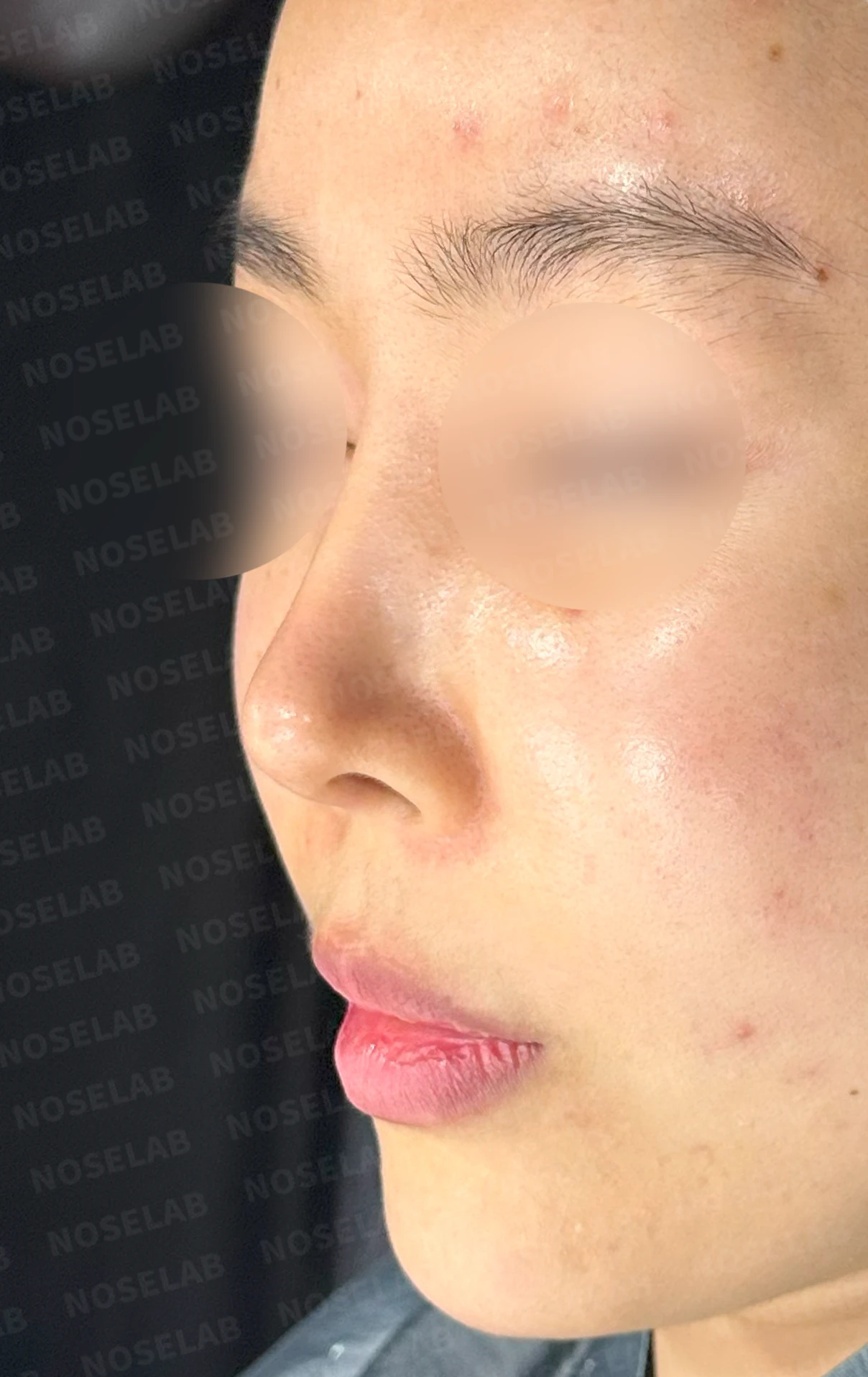코가 들리고 콧기둥이 꺼지며 코끝이 찝혀 보이는 이유, 복합 교정은 어떻게 하나 — 수술 전 / 수술 직후 0일 직후 사진은 부기가 있는 상태로 최종 결과와 다를 수 있습니다.