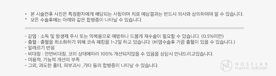 휜코와 콧대·코끝의 자가늑연골 비개방 교정 방법 — 본문 사진 7