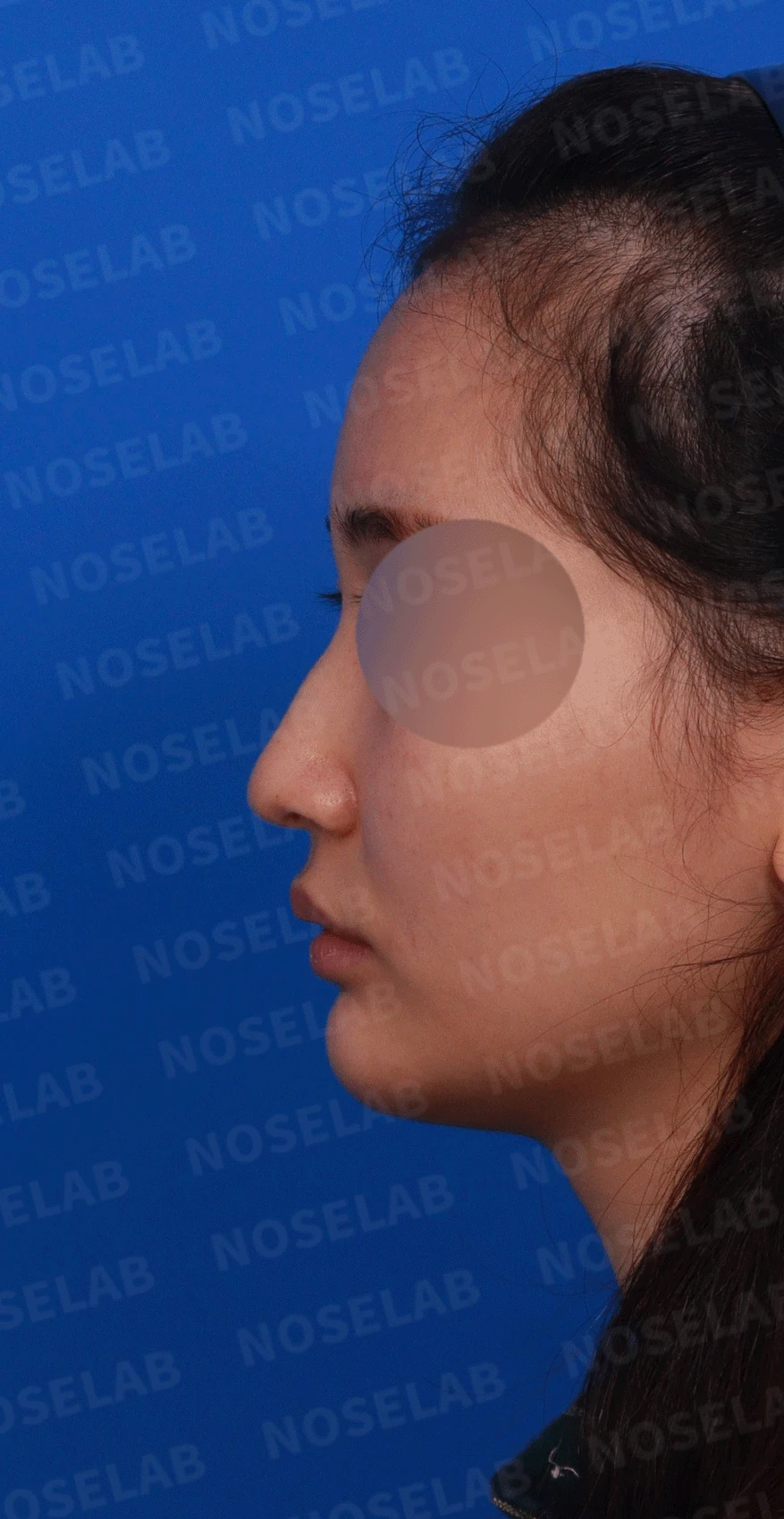 웃을 때만 화살코가 되는 이유와 코끝 연골 교정 방법 — 디자인 상담 정면, 좌측 측면, 비스듬한 측면 사진입니다.